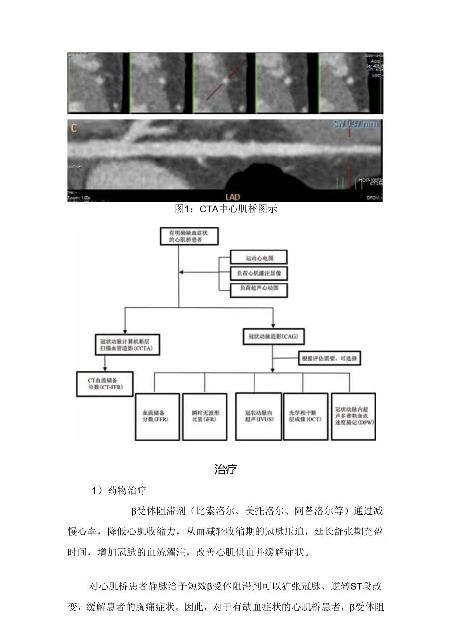 临床心肌桥疾病概念、临床症状、诊断及治疗要点.docx_第3页