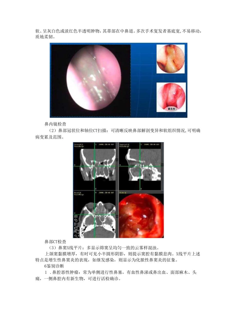 鼻息肉的诊断和治疗及并发症(探讨).docx_第3页