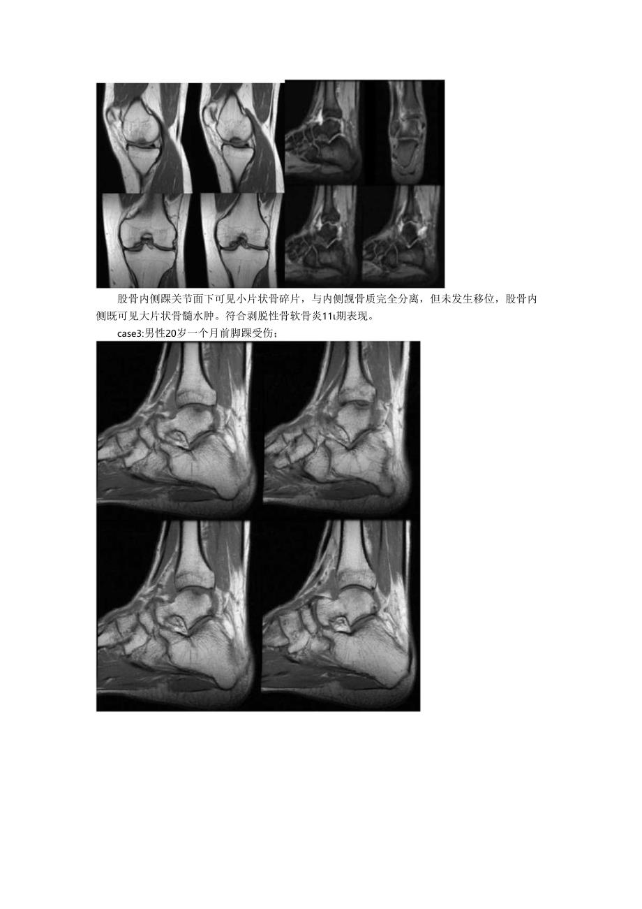 剥脱性骨软骨炎的影像诊断与影像表现.docx_第3页