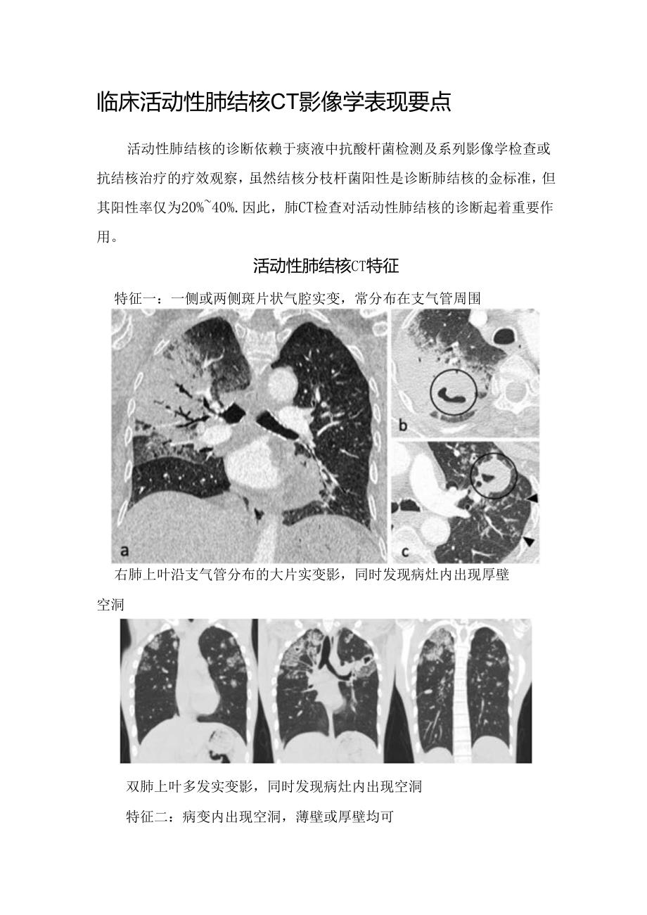 临床活动性肺结核CT影像学表现要点.docx_第1页