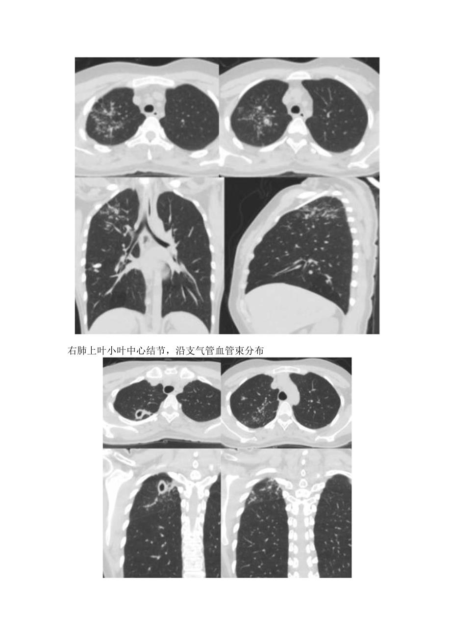 临床活动性肺结核CT影像学表现要点.docx_第3页