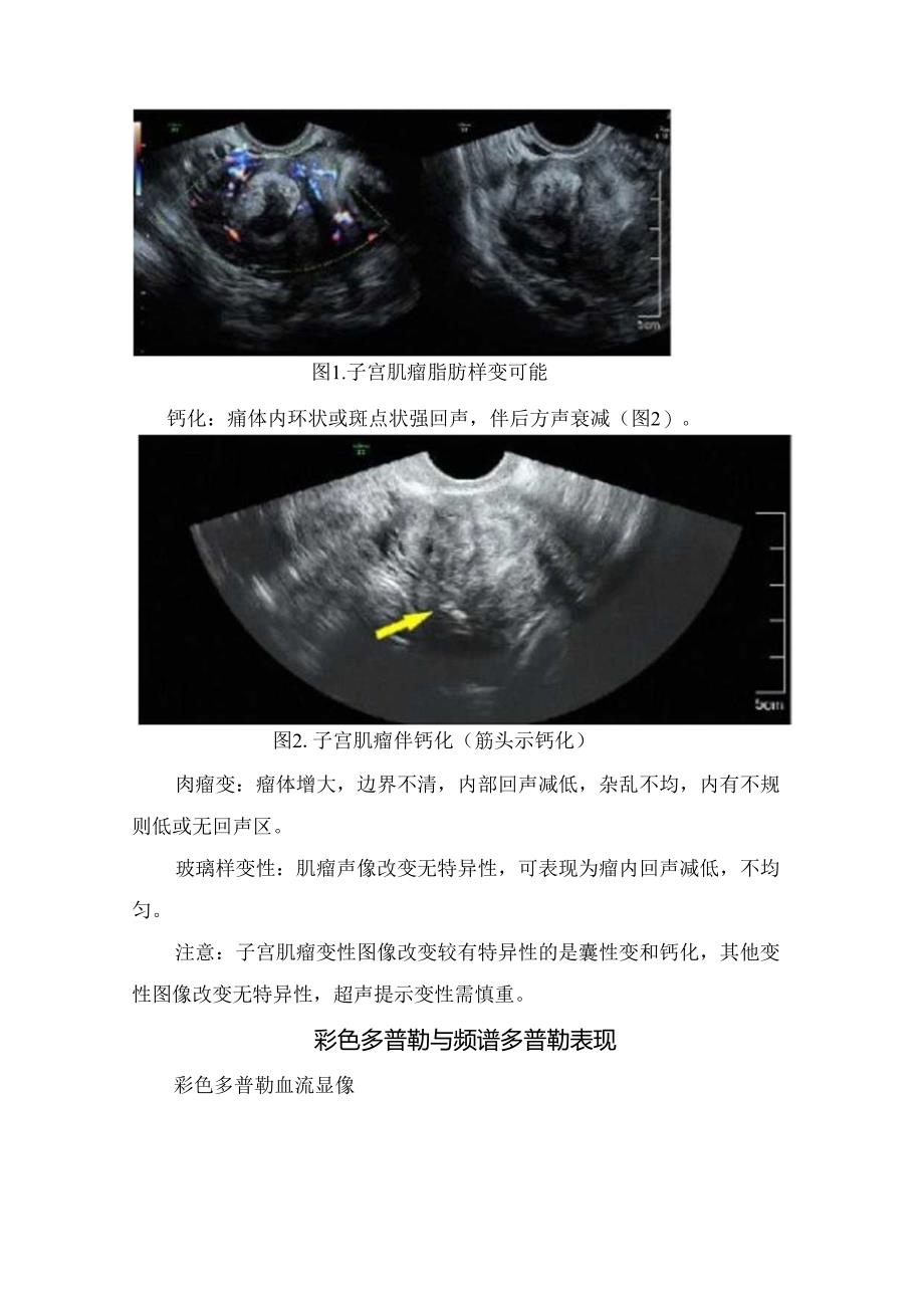 临床子宫肌瘤二维超声表现、肌瘤内部回声特征、肌瘤变性声像、彩色多普勒与频谱多普勒表现及鉴别诊断.docx_第3页