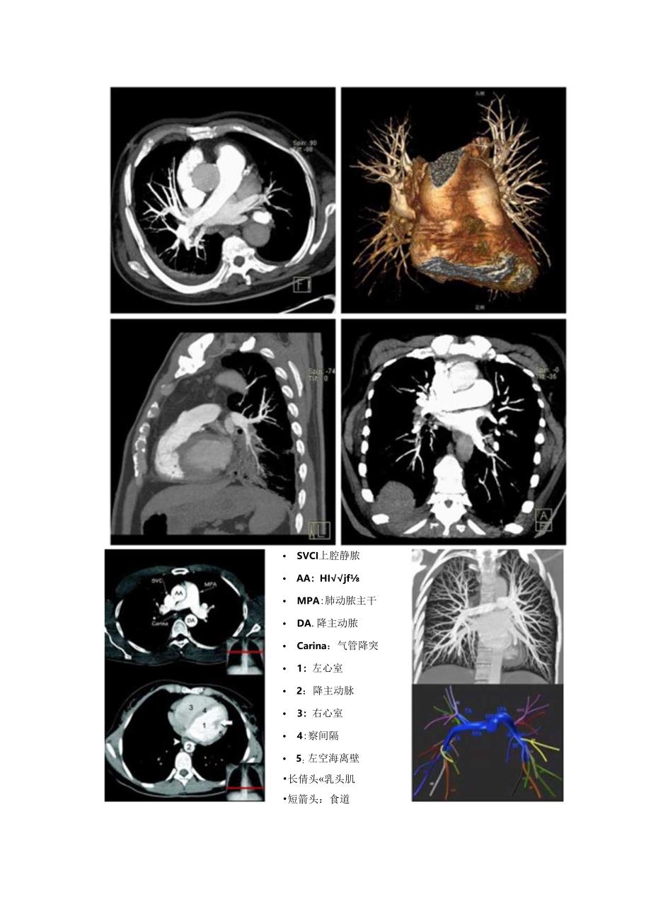 临床肺栓塞诊断策略、血管结构、急慢性肺栓塞CTPA征象存在伪影要点.docx_第2页