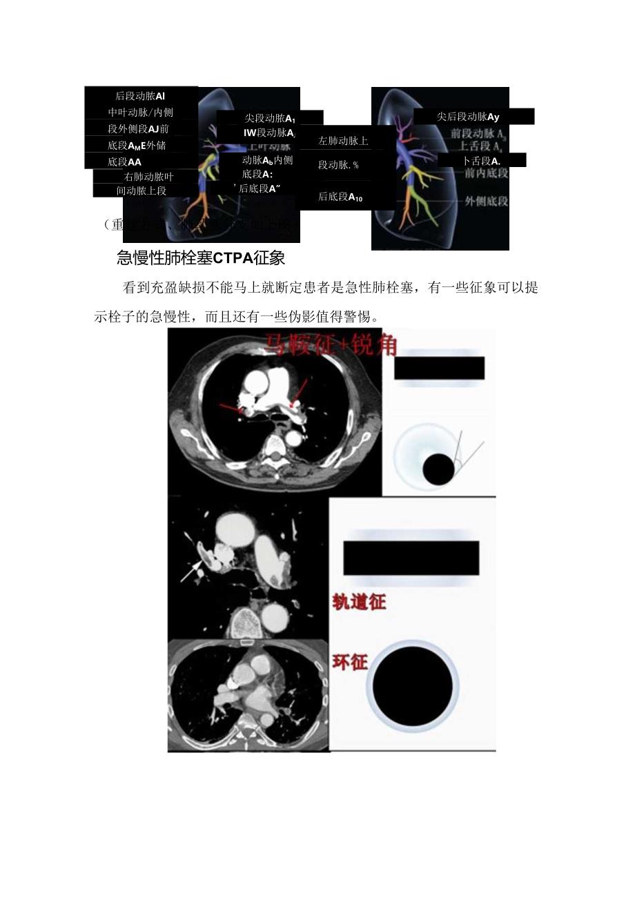 临床肺栓塞诊断策略、血管结构、急慢性肺栓塞CTPA征象存在伪影要点.docx_第3页