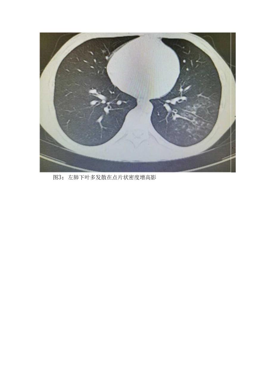 临床支原体肺炎警惕现象、传染性、影像学特征性表现、用药及预防要点.docx_第3页