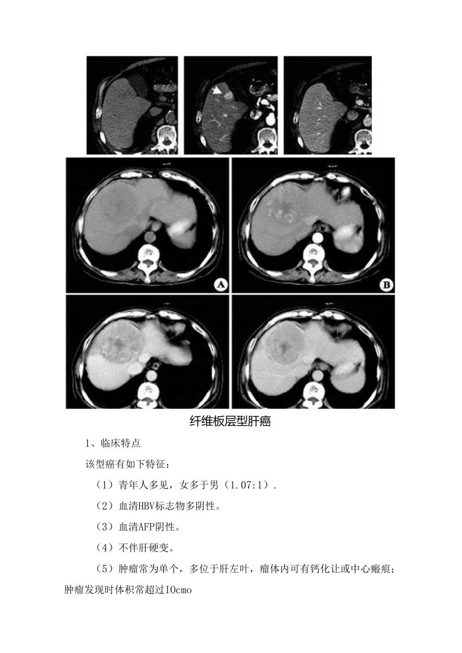 临床原发性肝细胞癌、纤维板层型肝癌、肝血管瘤、肝腺瘤、胆管癌、转移瘤、血管肉瘤、错构瘤等肝脏富血供病变病理、临床特点及影像学表现.docx_第3页