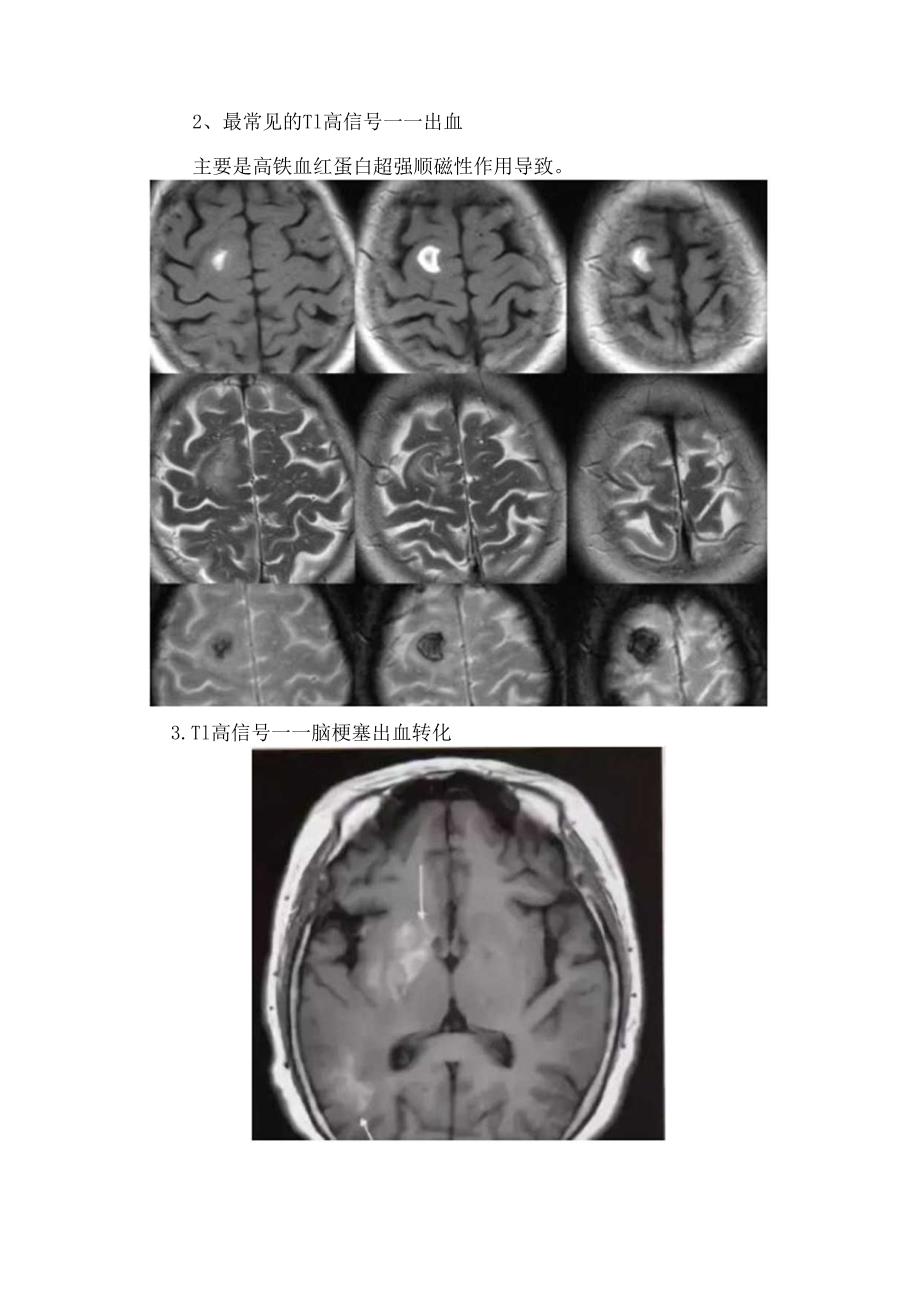 临床T1高信号指示意义及胼胝体脂肪瘤、出血、脑梗塞出血转化等疾病影像学表现.docx_第2页