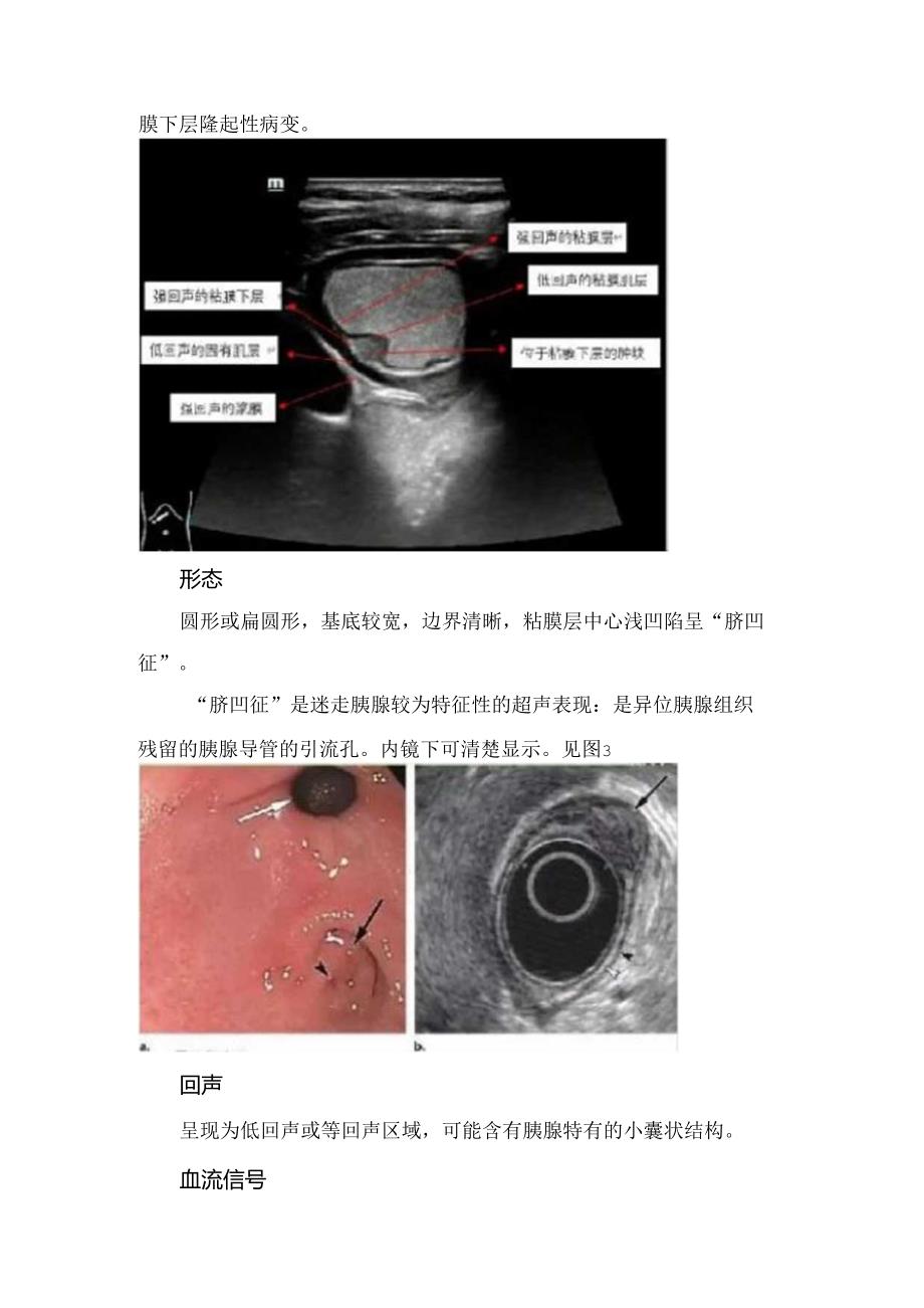 迷走胰腺临床表现、癌变潜在风险原因、超声声像图表现、鉴别诊断及临床处理策略.docx_第3页