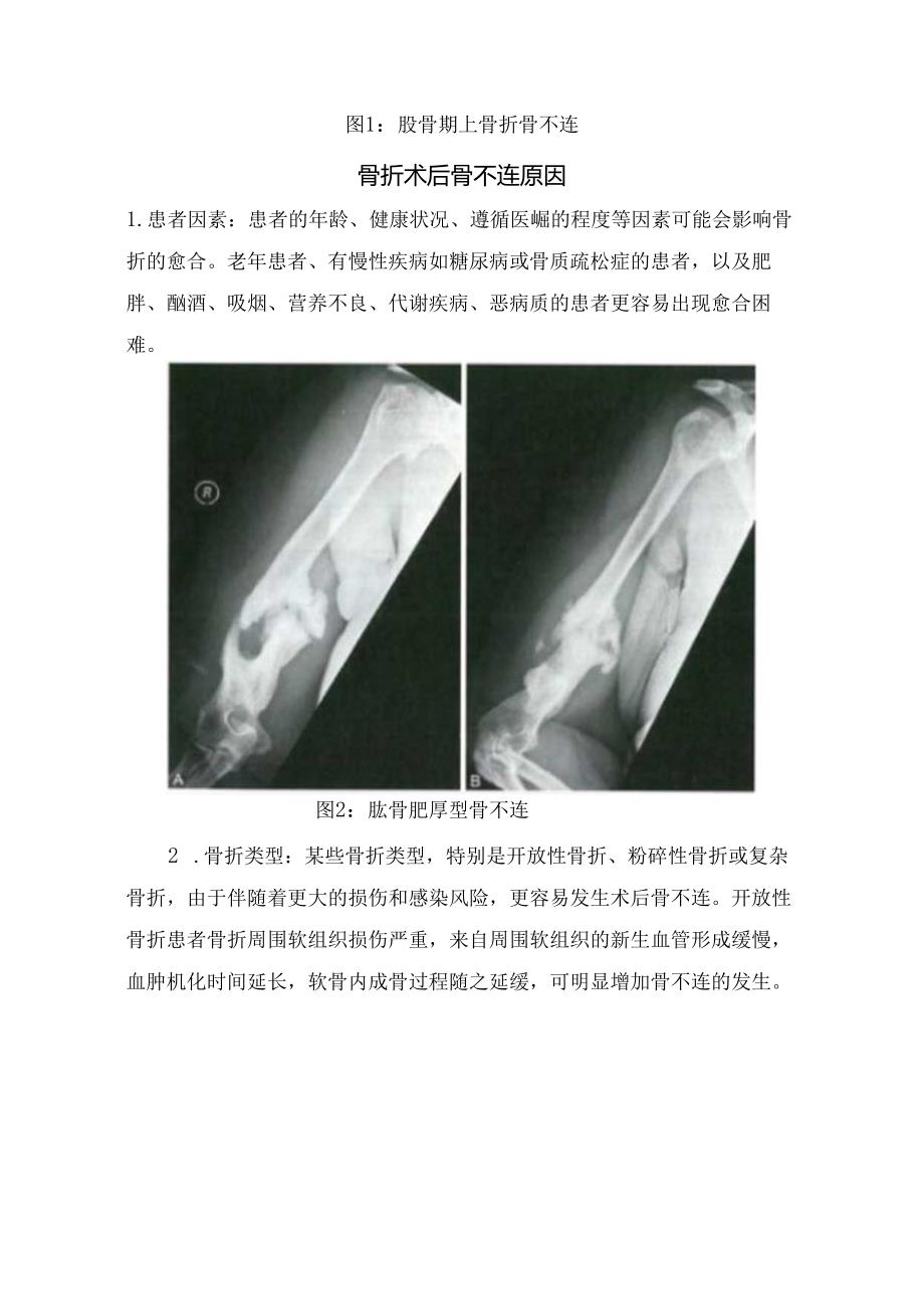 临床骨折术后骨不连原因、治疗方法及要点总结.docx_第2页