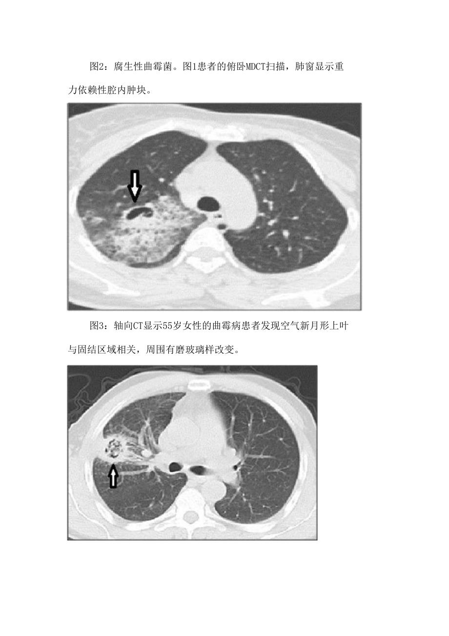 临床曲霉菌、过敏性支气管肺曲霉菌病、半侵入性或慢性坏死性曲霉菌病、侵袭性曲霉菌病等肺曲霉菌病影像表现及鉴别诊断.docx_第3页