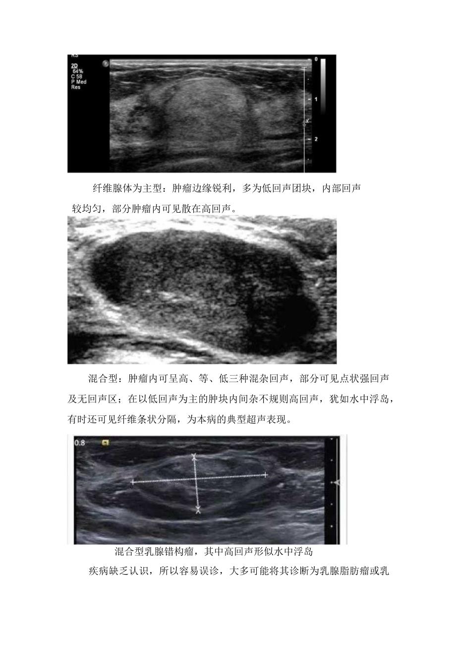 临床乳腺肌样错构瘤概念、病理分类、超声表现及治疗要点.docx_第3页