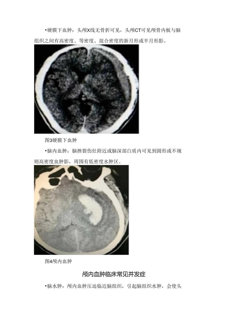 常见颅内血肿特征、源、部位、临床表现及治疗要点.docx_第3页