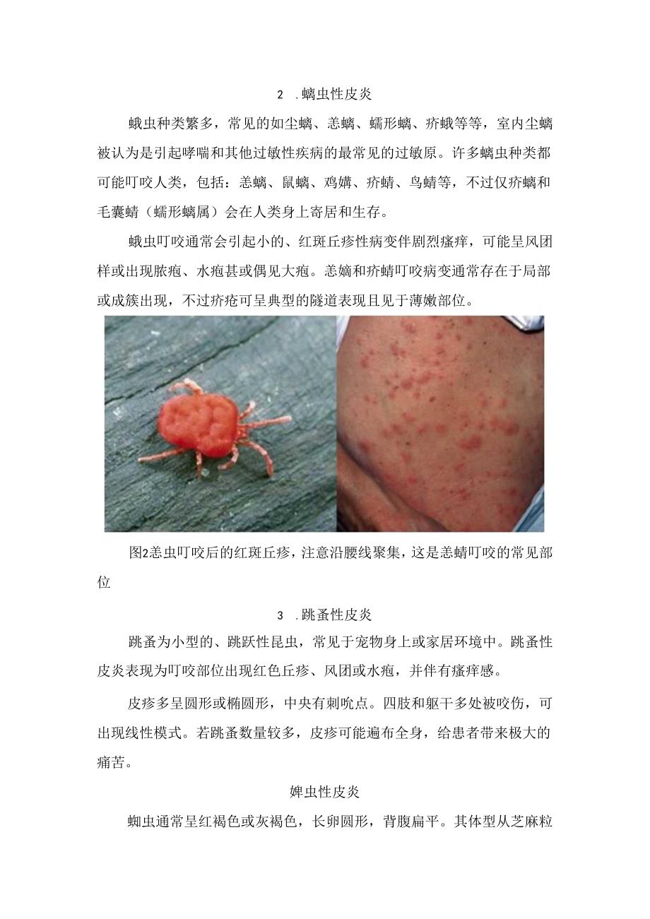 蚊虫叮咬、螨虫性皮炎等各类虫咬皮肤表现及要点总结.docx_第2页