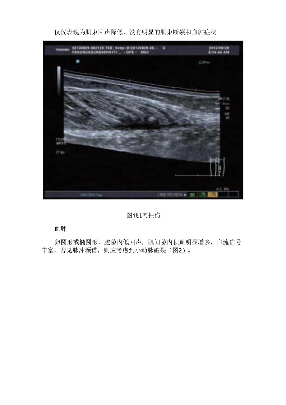 临床肌肉损伤病理、超声检.docx_第2页