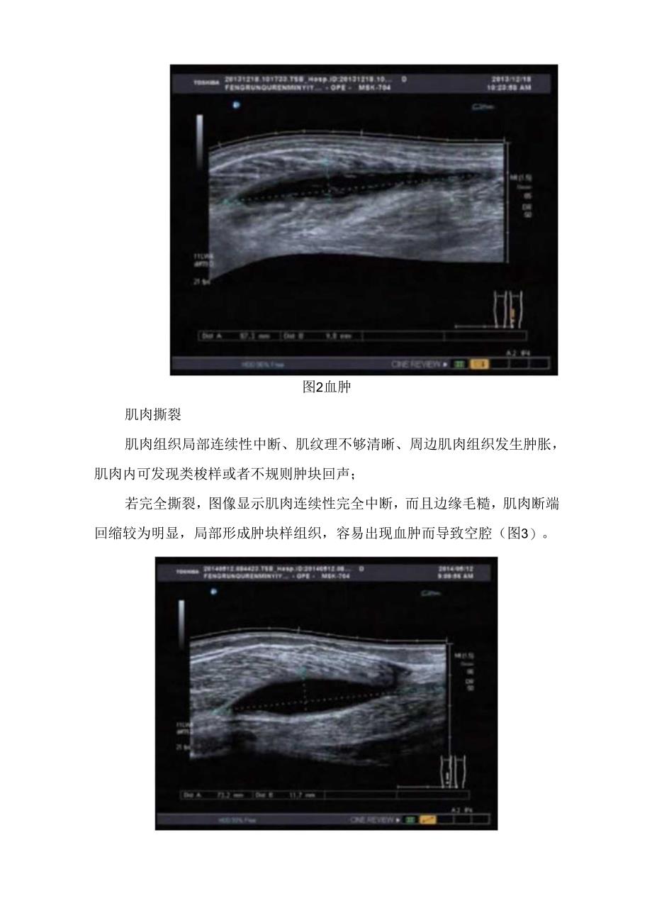 临床肌肉损伤病理、超声检.docx_第3页