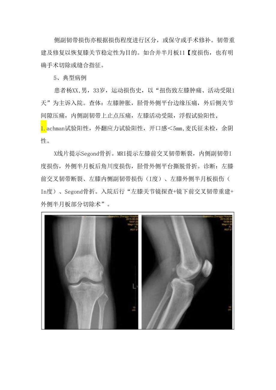 临床Segond骨折定义、发病机制、诊断机制及治疗要点.docx_第2页