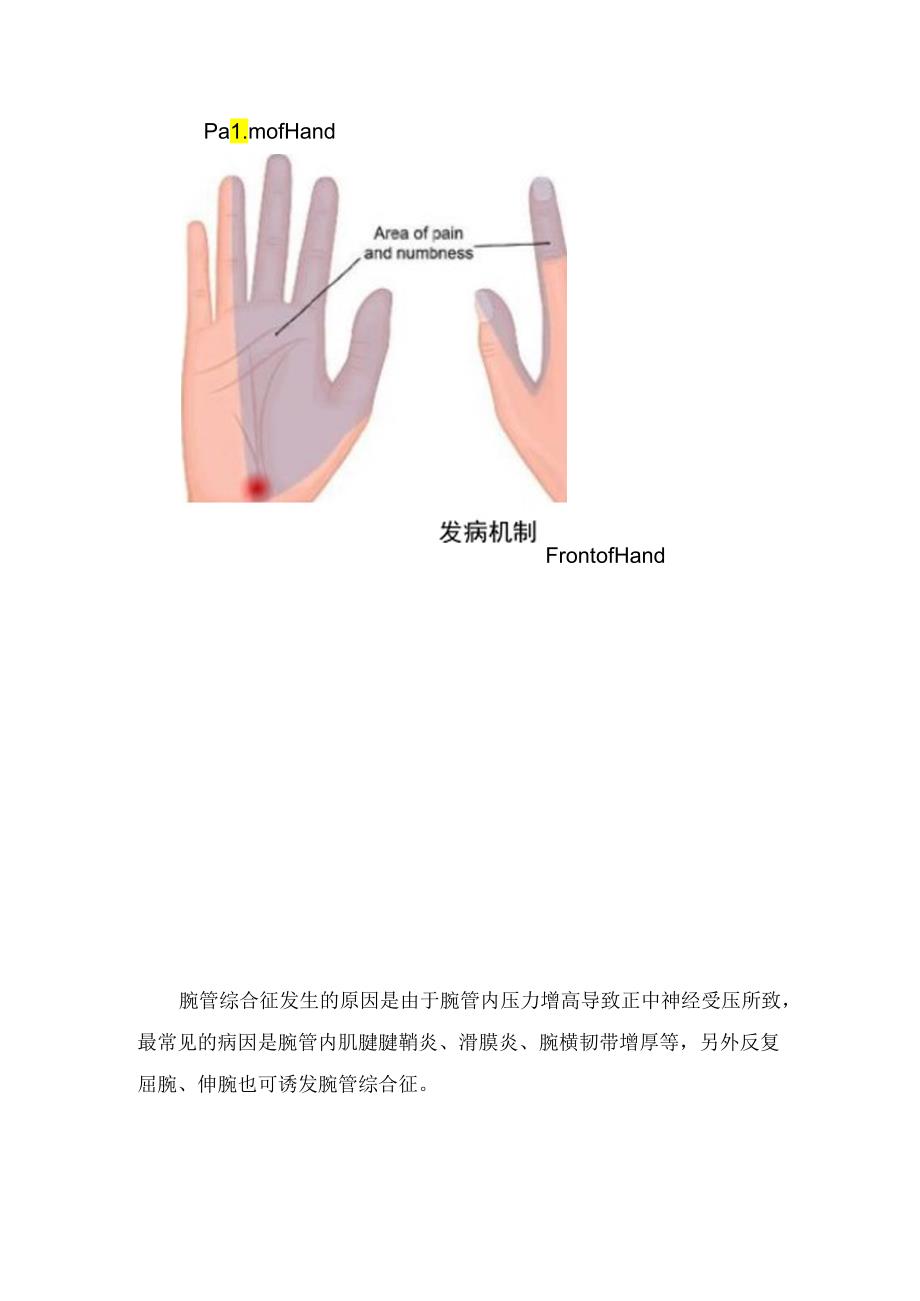 临床腕管综合征病理、临床症状、发病机制、病因、体格检查、超声检查及治疗方法.docx_第2页