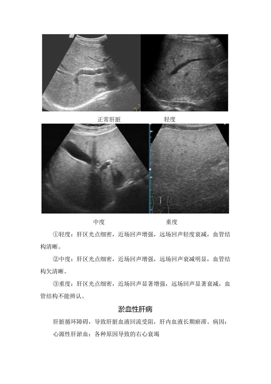 临床脂肪肝、淤血性肝病等常见肝脏弥漫性病变病因、因素及超声诊断.docx_第3页