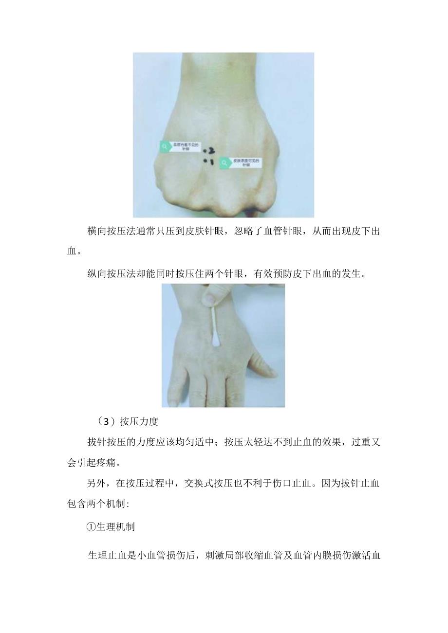 临床穿刺部位淤青形成原因、预防及处理要点.docx_第3页