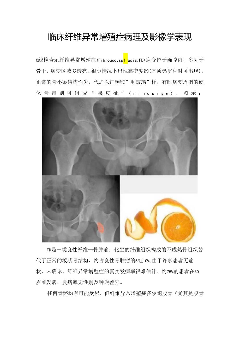 临床纤维异常增殖症病理及影像学表现.docx_第1页