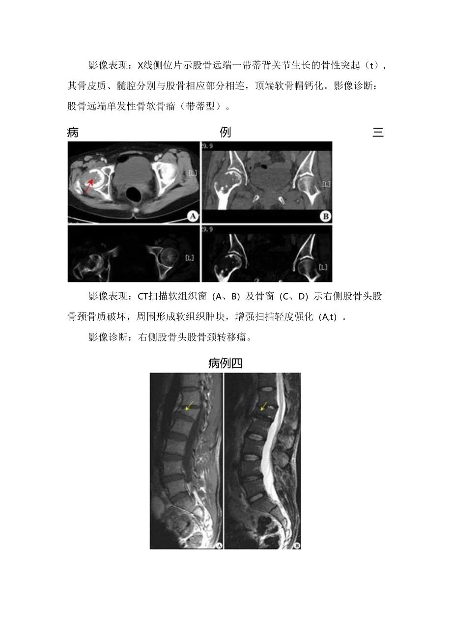 临床骨质疏松、股骨远端单发性骨软骨瘤、肱骨髁上骨折等肌骨影像诊断要点.docx_第2页