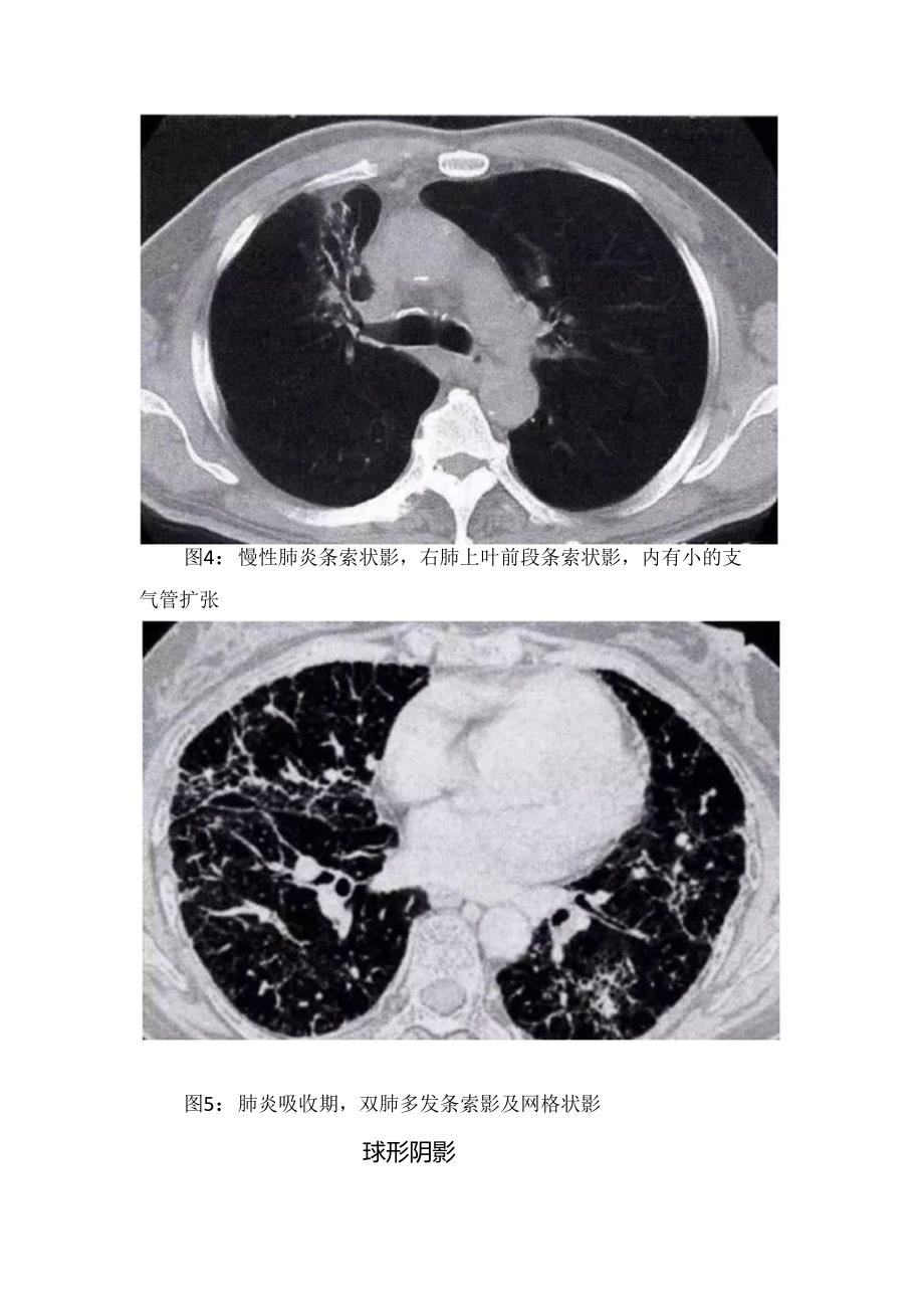 临床小结节影、 肺段及大叶阴影、球形阴影、空洞、胸膜病变等肺部炎症CT表现.docx_第3页