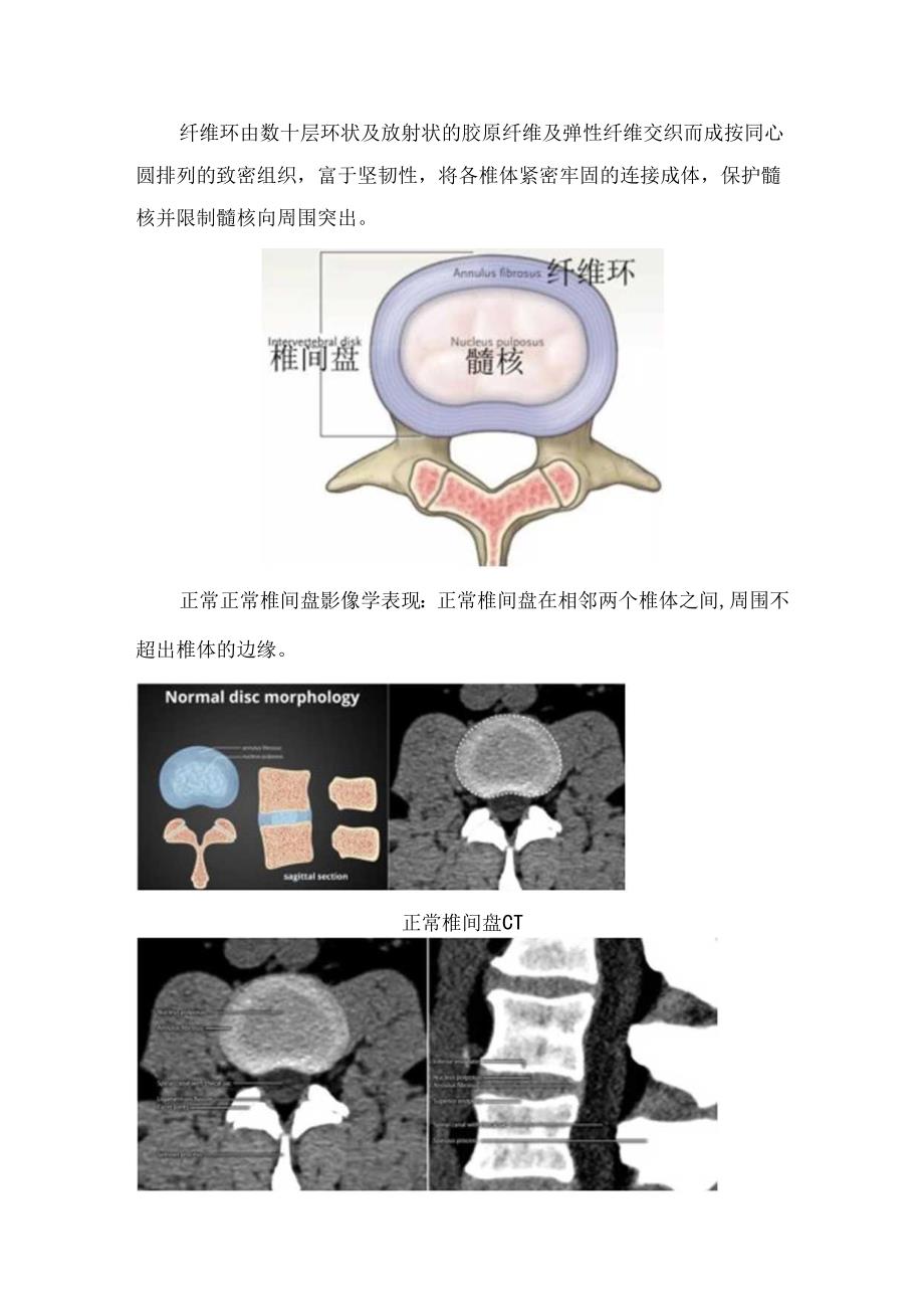 临床椎间盘膨出型、突出型、脱出型、游离型鉴别和诊疗要点.docx_第2页