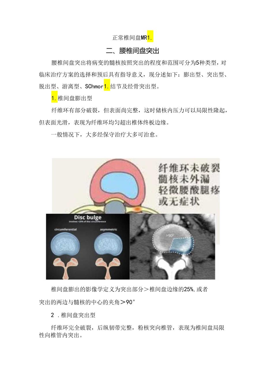 临床椎间盘膨出型、突出型、脱出型、游离型鉴别和诊疗要点.docx_第3页