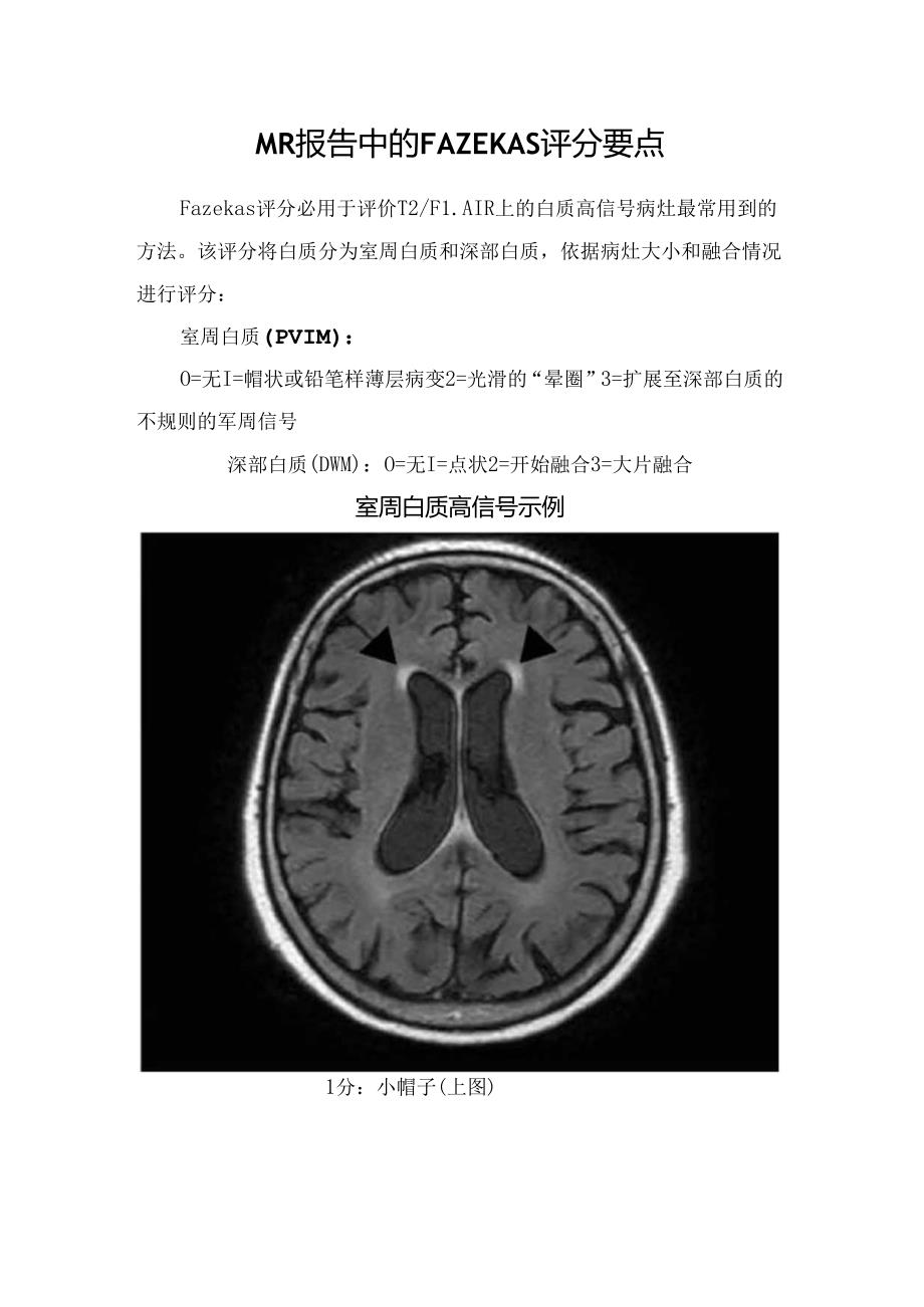 MR报告中的FAZEKAS评分要点.docx_第1页