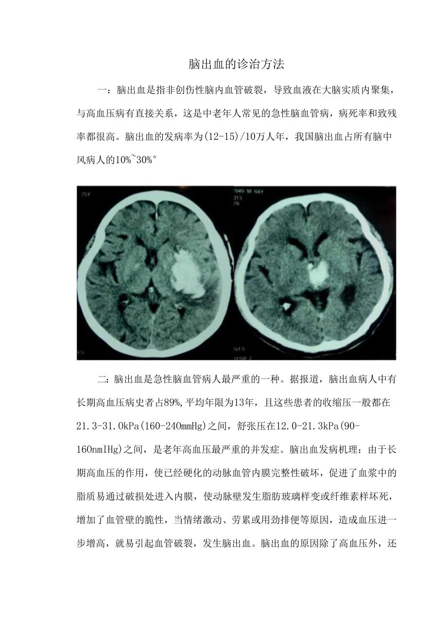 脑出血的诊治方法.docx_第1页