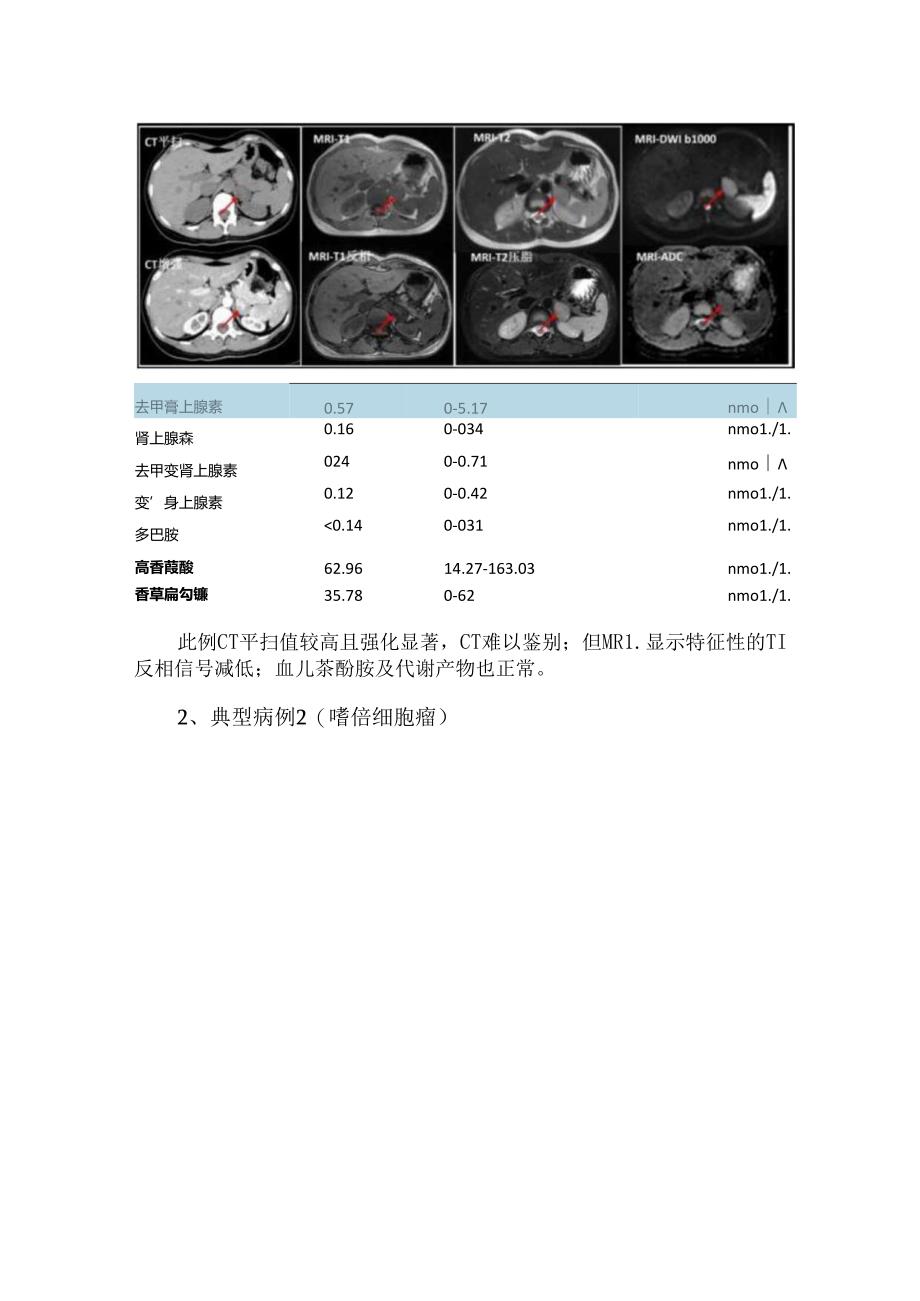 嗜铬细胞瘤的鉴别诊断.docx_第2页