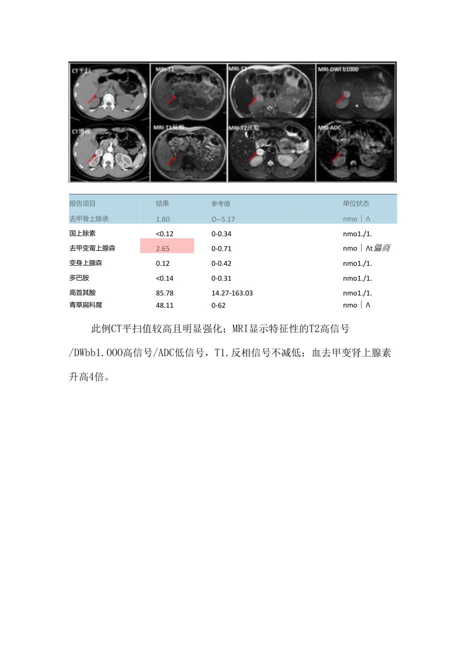 嗜铬细胞瘤的鉴别诊断.docx_第3页