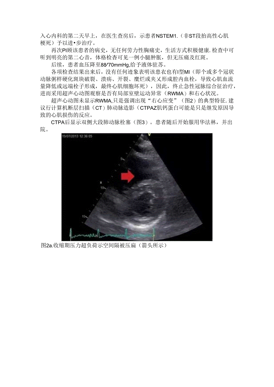 超声心动图排除非ST段抬高型心肌梗死（心脏超声造影诊断非ST段抬高型心肌梗死患者梗死相关血管的应用）.docx_第2页