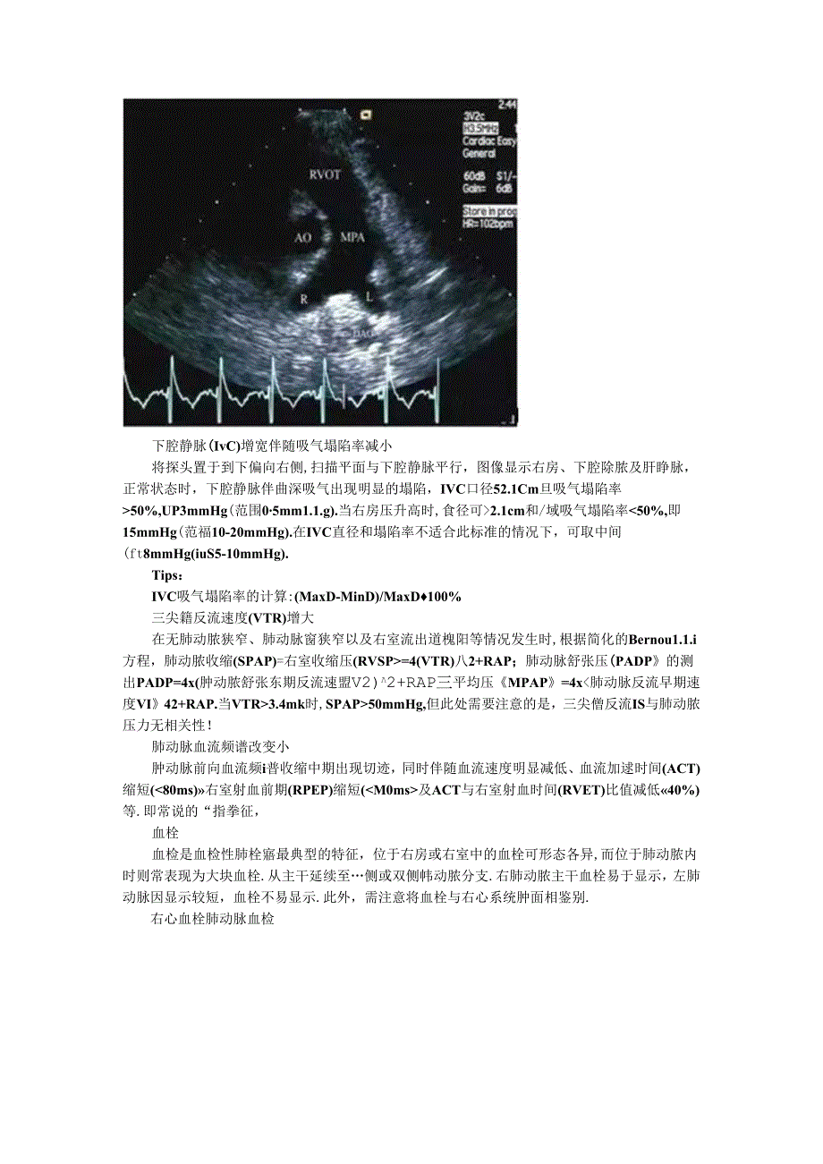 超声心动图九大征象看肺动脉栓塞与超声鉴别诊断要点.docx_第3页